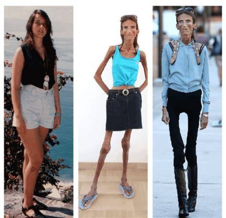 Discovering the Skinniest Person in the World (2023): A Fascinating Journey